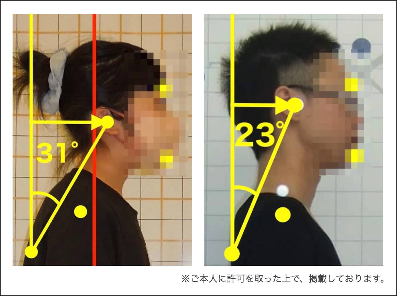 頭が前方に移動しながらおでこに対してアゴがより前に出た「アゴ型」姿勢